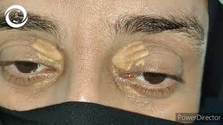 Xanthelasma palpebrarum