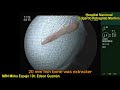 FOREIGN BODY ENDOSCOPIC EXTRACTION OF THE ESOPHAGUS (FISHBONE)