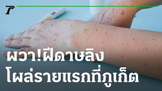 ผวา! ฝีดาษลิงโผล่รายแรกที่ภูเก็ต | 22-07-65 | ห้องข่าวหัวเขียว