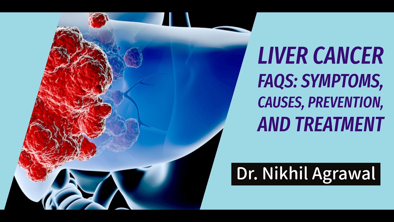 Liver Cancer Faqs Symptoms Causes Prevention And Treatment Dr