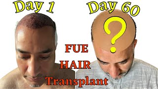 2 months post FUE Hair Transplant / Results Before and After after Hair Implantation in Turkey