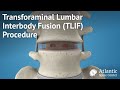 Transforaminal Lumbar Interbody Fusion(TLIF) Procedure