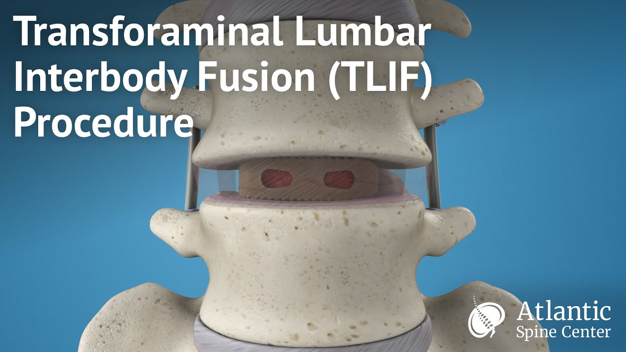 Lumbar Spine Fusion
