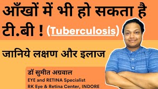 आँखों में टी.बी. (Tuberculosis) ?  बहुत सारे eye doctors भी कर देते  हैं इसे मिस l