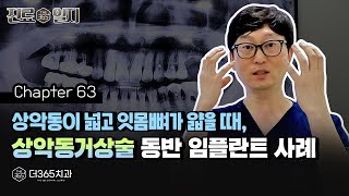 상악동이 넓고 잇몸뼈가 얇을 때, 상악동거상술 동반 임플란트 사례 | 【더365치과】 진료일지 #63