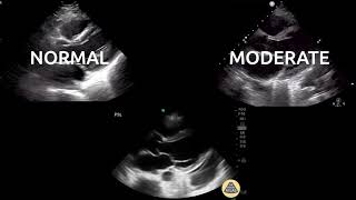 Evaluating for Reduced Ejection Fraction (PSLA)