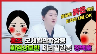 홍조 혈관확장 화염상모반 체리혈관종 정맥호 얼굴의 붉음증 피부과 브이빔레이저 엑셀브이레이저로 치료 가능합니다.