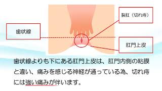 裂肛（切れ痔）【ららぽーと横浜クリニック】