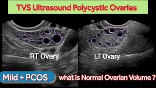 PCOS Polycystic Ovaries | Grading Mild |  Polycystic Ovarian Syndrome | PCOD | Ultrasound