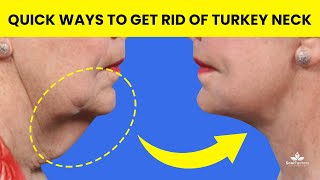 How To Get Rid Of Turkey Neck: Exercises, Lifestyle Tips & Surgical Options | SoulFactors