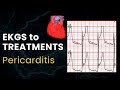 Pericarditis | ECGs to Treatments