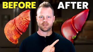 How to Fix Your Fatty Liver at Home...5 Tips