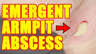 EMERGENT ARMPIT ABSCESS