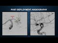 PulseRider treatment of an anterior communicating artery aneurysm