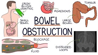 Understanding Bowel Obstruction