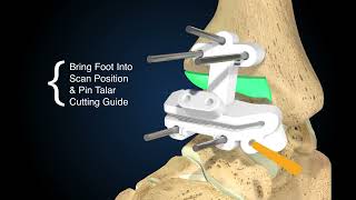 Exactech Vantage Ankle PSI Animation