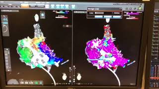 ripple mapping for atypical right atrial flutter