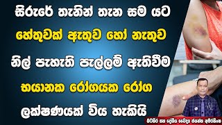 සිරුරේ සම යට නිල් පැහැති පැල්ලම් ඇතිවීම බරපතල රෝගයක ලක්ෂණයක් විය හැකියි Bruising | Ecchymotic patch