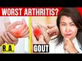 The 3 Most SEVERE Forms of Arthritis!