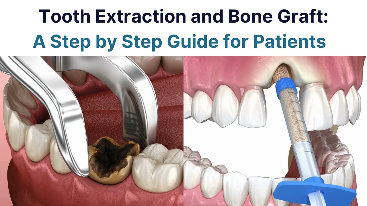 Healing Of Tooth Extraction And Bone Graft At Colleen Miller Blog