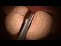 UroLift® System for BPH Procedure Animation