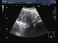 Ultrasound Video showing a large mass in uterus.