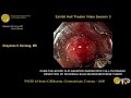 over the scope clip assisted endoscopic full thickness resection