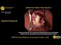 over the scope clip assisted endoscopic full thickness resection