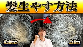 髪を増やすために自分で医療ができることは？ガイドラインより～薄毛・ハゲ治療に効果的～