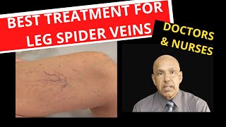 What Are Leg Spider Veins and How are they removed? | Causes and Treatment by Microsclerotherapy