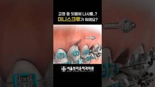 치아교정용 나사! 미니스크류란?