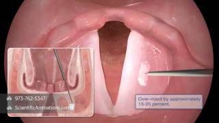 Vocal Cord Paralysis Surgery