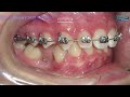 implant site development the magic of orthodontics trailer