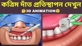 কৃত্রিম দাঁত কিভাবে লাগানো হয় দেখুন। Dental Implant  #3danimation #viral #cartoon #asmr  পর্ব- ১৩