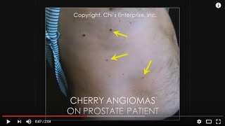 Dr Chi's Fingernail and Tongue Analysis - Cherry Angiomas and Liver/Prostate Problems