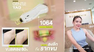 YAG Laser 1064 | คุณน้ำหวาน zaza บอกเลยต้องทำ ขนหลุดถึงรากโคน | Hair Removal