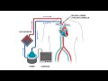 ECMO Outcomes in COVID-19 Patients