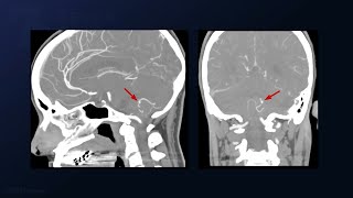 Suboccipital Craniotomy and Telovelar Approach for P4 PICA Aneurysm Clipping