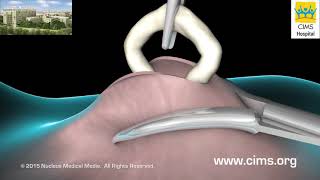 Vasectomy – CIMS Hospital