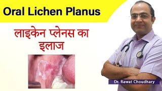 Oral Lichen Planus Treatment | लाइकेन प्लानस का इलाज | Best Homeopathic Doctor