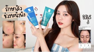 ✨ACNE DIARY รักษาสิวช่วงหน้าพัง + ใช้ La Roche-Posay Effaclar เจลล้างหน้าสูตรไหนดี | Babyjingko