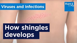 How shingles develops