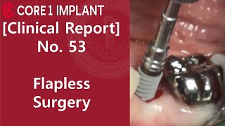 [CYBERMED Clinical Report] #35 implant placement with Flapless Surgery