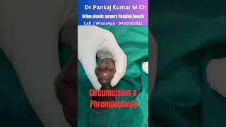 Stapler circumcision | Laser phrenuloplasty | Circumcision surgery in Ranchi | laser phrenuloplasty