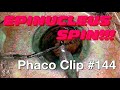 Phaco Clip #144 - The Epinucleus SPIN!