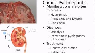 Pathophysiology   Renal 3   UTI Acute and Chronic