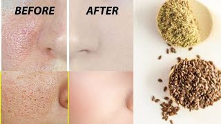 Flaxseeds Face Mask| How To Get Rid Of Large Open Pores| Open Pores Treatment At Home| 100% results!