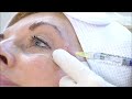 mesotherapy at the aesthetic medicine skin clinic in london and birmingham