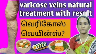 Varicose veins 😲🍑 natural treatment with result | வெரிகோஸ் வெயின்ஸ்