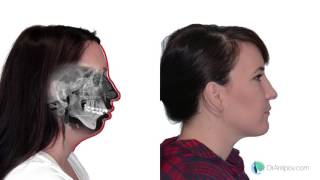 Jaw Surgery, a look at the before and after - Case 4